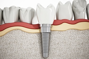 Springfield dental implants Animation of implant crown