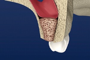 Sinus lift