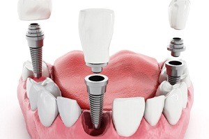 Multiple dental implants