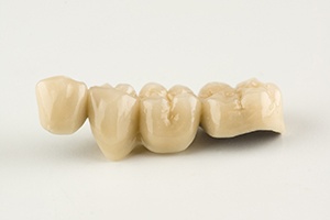 Complete dental bridge with two crowns and two pontics