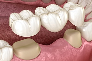 Illustration of dental bridge being placed on natural teeth