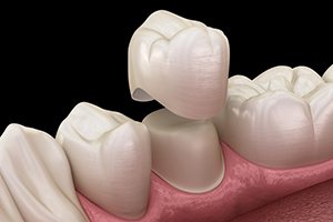 diagram of crown going onto tooth