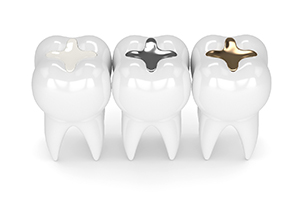 A digital image of three teeth, each with a different type of filling (a composite, silver, and gold filling)