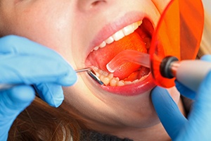 A dentist using a curing light to harden composite resin into place