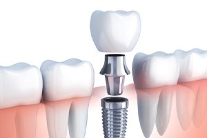 Digital illustration of a dental implant replacing a single missing tooth in Springfield  