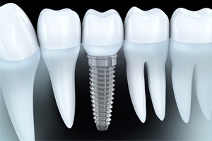 Dental Implant