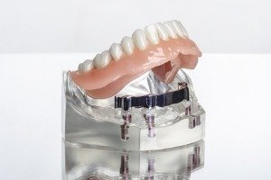 Model implant denture