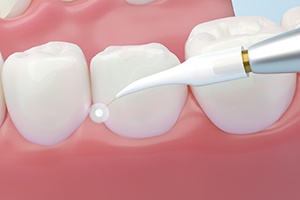A CGI image of a laser gum disease treatment