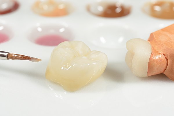 modal of a dental crown