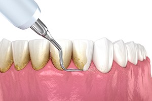 Illustration of scaling and root planing performed on lower teeth