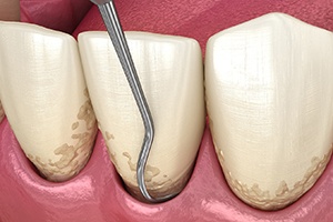 Illustration of a tooth undergoing scaling and root planing