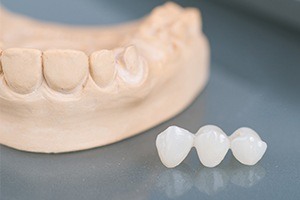 Springfield restorative dentist Fixed bridge and smile model