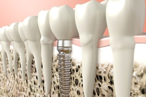 computer illustration of an implant-retained crown in Springfield