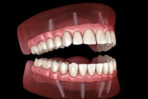 implant-retained denture