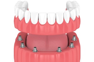 model of implant-retained denture