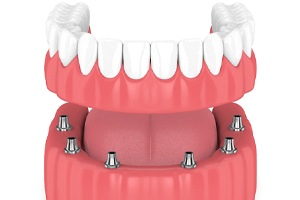 model of implant-retained denture