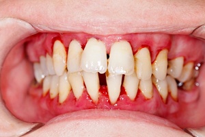 A mouth with significant gum disease.