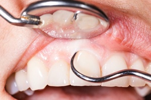 A mouth receiving scaling and root planing.
