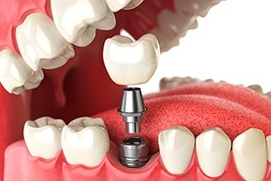 Animation of implant supported dental crown