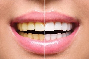 before and after teeth whitening