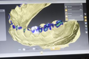 digital teeth rendering