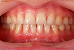 Mildly inflamed gum tissue.