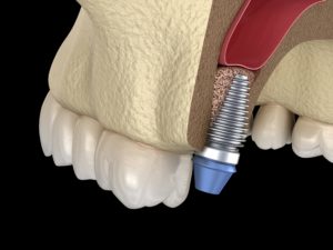 dental implant