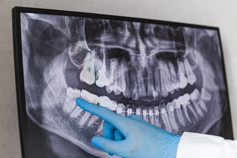 A hand pointing to a dental X-ray