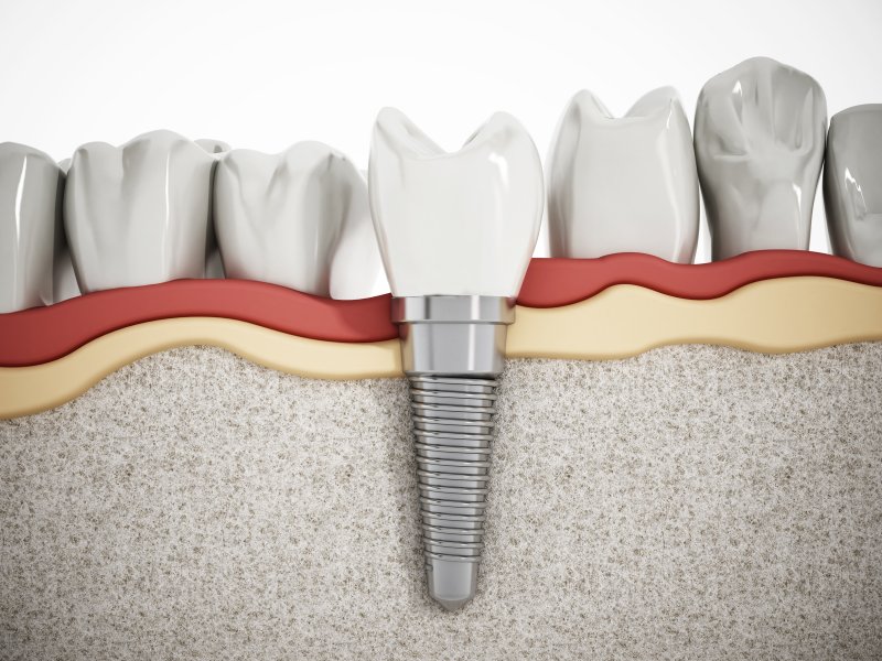 3-D diagram of a dental implant