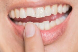 Person pointing to broken tooth.