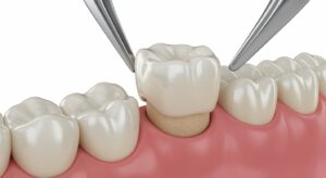Digital rendering of crown being fitted onto tooth by dental tool.
